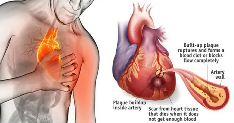 How To Stop A Heart Attack in Just 60 Seconds – Its Very Popular Ingredient In Your Kitchen