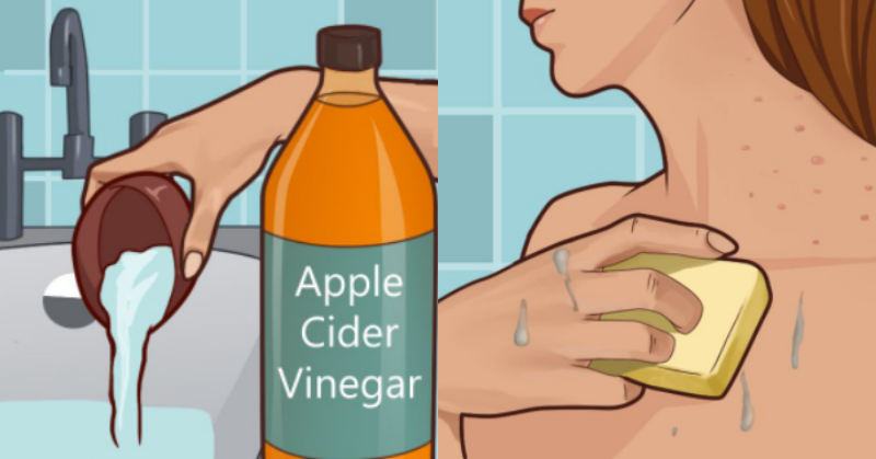 Put Apple Cider Vinager On Your Face Then See What Happens To Your Age Spots, Acne And More