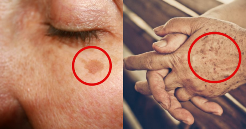 Two ingredients to get rid of brown spots on your skin
