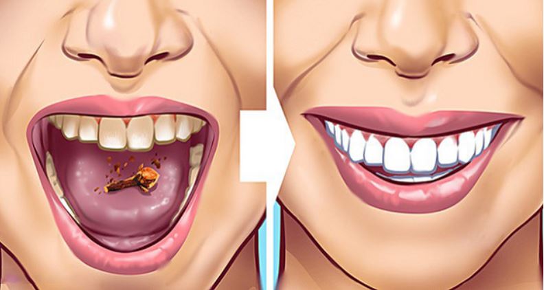 9 cách đơn giản giúp loại bỏ nhanh cao răng tại nhà mà không hề tốn kém