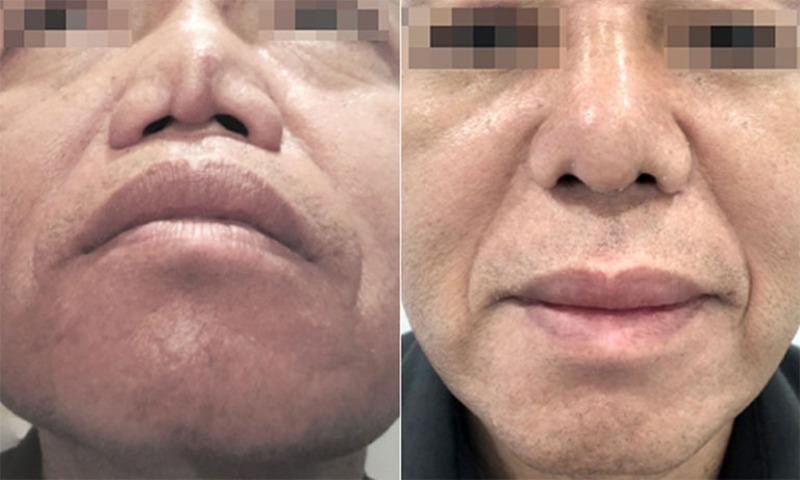 Hậu quả khi về già với những người nâng mũi: Giờ nhìn đẹp thôi, vài năm nữa mới thấm thía