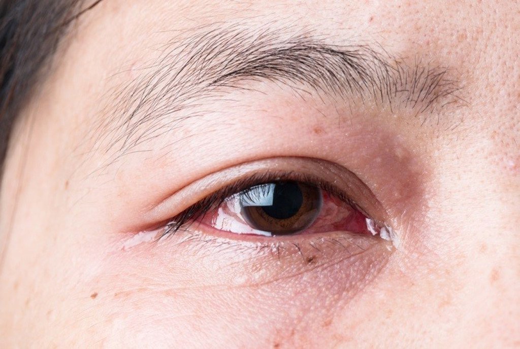 Bệnh đau mắt đỏ: Triệu chứng, nguyên nhân và những lưu ý cần biết