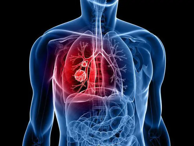 4 dấu hiệu cảnh báo UT phổi đang đến gần