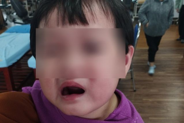 Bé gái 2 tuổi bị m.éo m.iệng sau khi được bố mẹ chở đi chơi vào tối muộn