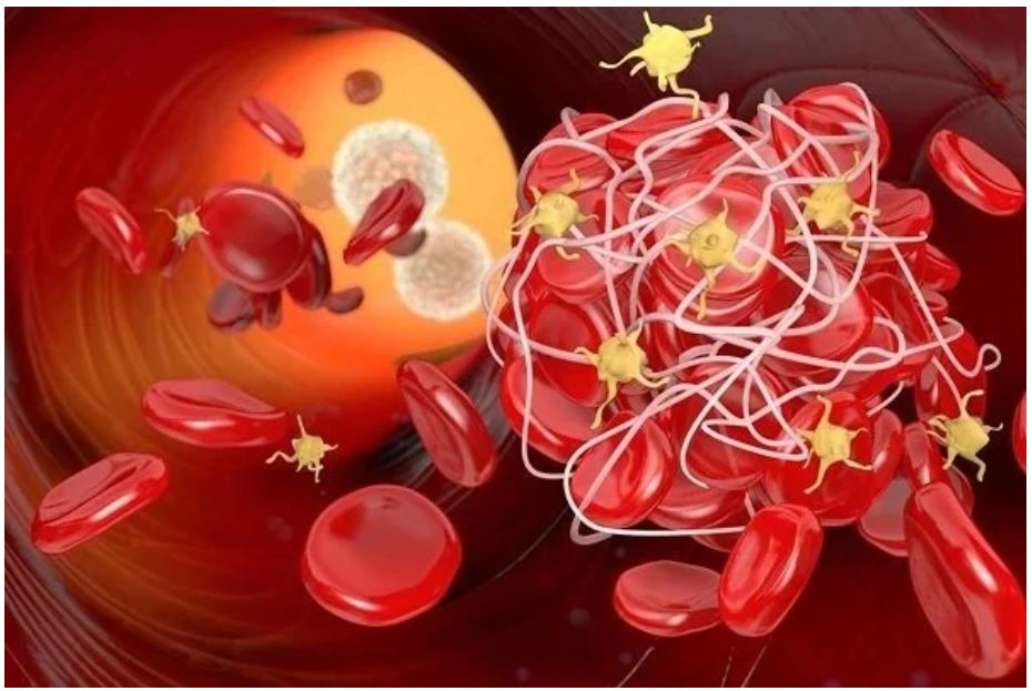 6 thói quen xấu làm tăng nguy cơ hình thành cục máu đông