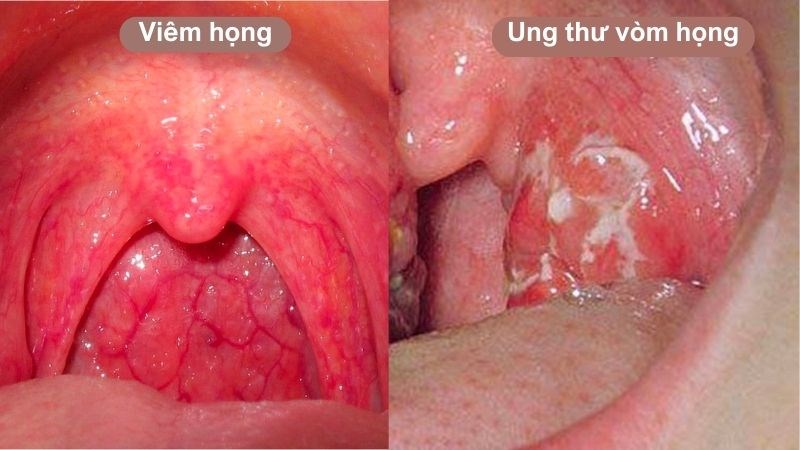 Cách phân biệt UT vòm họng và viêm họng thông thường