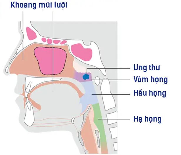 UT vòm họng