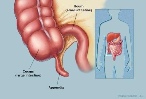 Các dấu hiệu và triệu chứng khẩn cấp của bệnh viêm ruột thừa