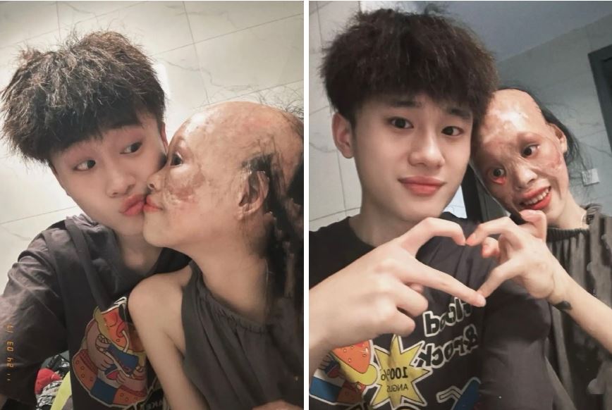 Sự thật về cô gái bỏng toàn mặt hy sinh ngoại hình để cứu mẹ bạn trai khỏi hoả hoạn